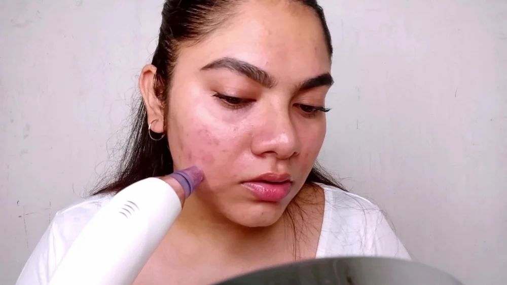 Derma Suction Blackhead Remover